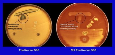 CAMP test for Group B Streptococcus identification