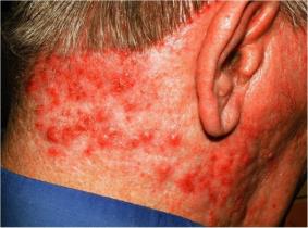 Staphylococcal skin infection