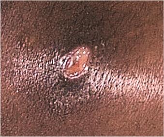 Staphylococcal furuncle (boil)