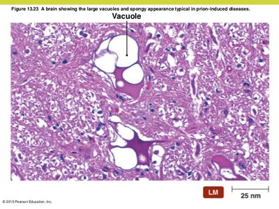 Spongy appearance in prion-induced disease