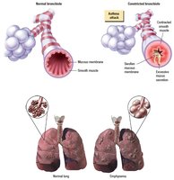 Diagram of normal and diseased lungs and bronchioles
