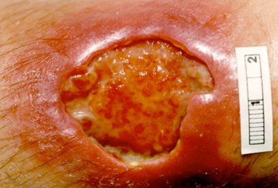 Buruli ulcer lesion on skin