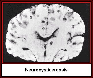 MRI of neurocysticercosis in the brain