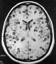 MRI of neurocysticercosis in the brain