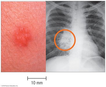 Diagnosis of tuberculosis: skin test and chest X-ray