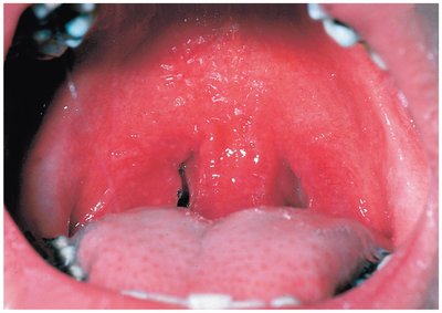 Clinical presentation of streptococcal pharyngitis (strep throat)