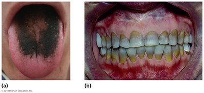 Side effects resulting from toxicity of antimicrobial agents