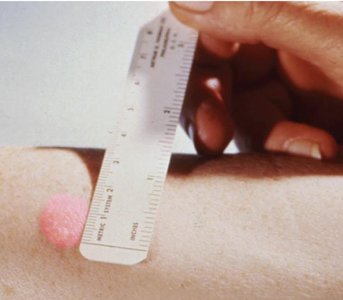 Tuberculin skin test (Type IV hypersensitivity)