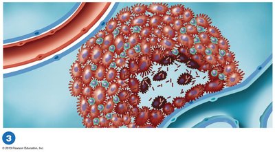 The pathogenesis of tuberculosis: caseous center formation
