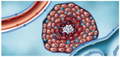 The pathogenesis of tuberculosis: tuberculous cavity formation