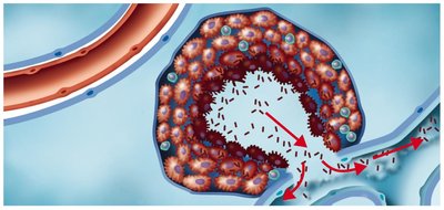 The pathogenesis of tuberculosis: rupture and dissemination