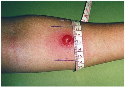 A positive tuberculin skin test on an arm