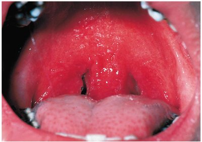 Streptococcal pharyngitis (strep throat)