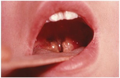 A diphtheria grayish membrane