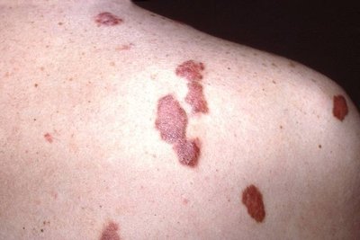 Kaposi's sarcoma lesions on skin