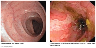 Endoscopic views of healthy and Crohn's disease-affected colon