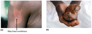 Tuberculoid and lepromatous forms of leprosy