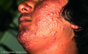 Leprosy affecting the face