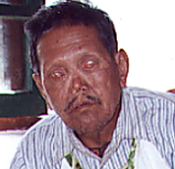 Leprosy affecting the eyes