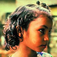 Leprosy with loss of pigmentation