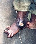 Leprosy with nodular lesions