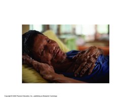 Leprosy with severe hand deformities