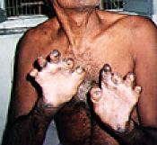 Leprosy with 'claw hands' deformity