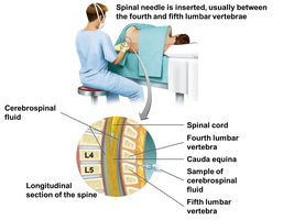 Spinal tap (lumbar puncture) procedure for collecting cerebrospinal fluid