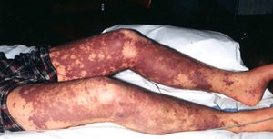 Characteristic rash of meningococcal meningitis on legs