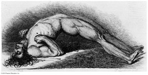 Advanced case of tetanus showing muscle rigidity