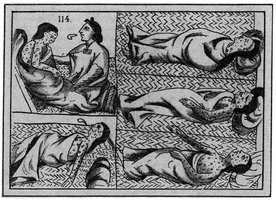 Historical depiction of smallpox