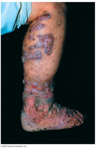 Leg with extensive lesions of chromoblastomycosis