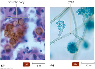 Microscopic differences between chromoblastomycosis and phaeohyphomycosis