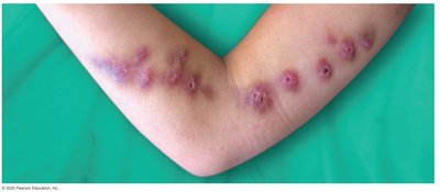 Sporotrichosis on the arm
