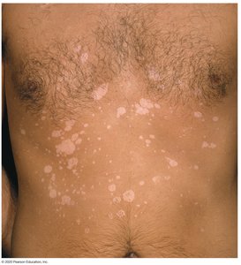 Pityriasis versicolor on the chest