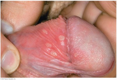 Genital herpes lesions