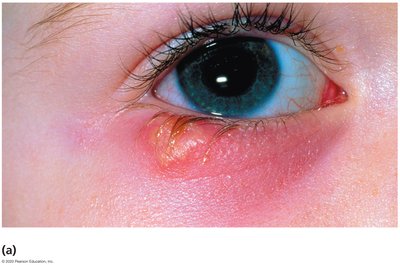 Ocular herpes lesion