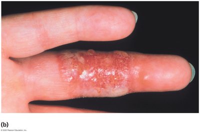 Whitlow on finger