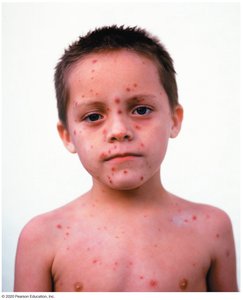 Chickenpox lesions on child