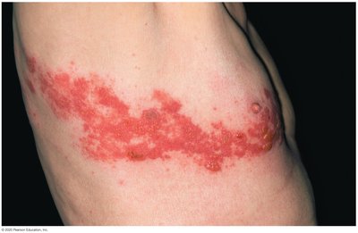Shingles rash along dermatome