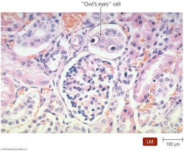 Owl's eye cell in CMV infection