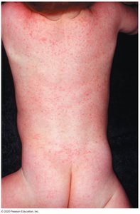 Roseola rash caused by HHV-6