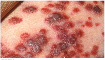 Kaposi's sarcoma lesions caused by HHV-8