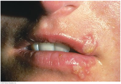Oral herpes lesions