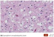 Spongiform encephalopathy brain tissue
