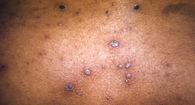 Varicella (chickenpox) rash as an example of inflammation, a response of innate immunity