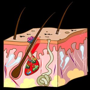 Diagram of skin layers showing microbial entry through hair follicles and sweat glands