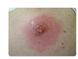 MRSA skin lesion with pus and redness