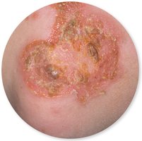 Impetigo lesion with honey-colored crusts