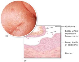 SSSS: Bullous lesions and skin separation